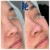 Middle Face Filler treatment 22 thumbnail