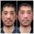 Middle Face Filler treatment 23 thumbnail