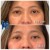 Middle Face Filler treatment 24 thumbnail