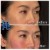 Middle Face Filler treatment 25 thumbnail