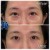 Middle Face Filler treatment 26 thumbnail
