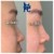 Middle Face Filler treatment 27 thumbnail