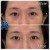 Middle Face Filler treatment 28 thumbnail