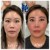 Middle Face Filler treatment 29 thumbnail