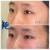 Middle Face Filler treatment 30 thumbnail