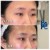 Middle Face Filler treatment 31 thumbnail