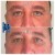 Middle Face Filler treatment 32 thumbnail