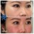 Middle Face Filler treatment 33 thumbnail