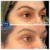 Middle Face Filler treatment 34 thumbnail