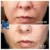 Middle Face Filler treatment 35 thumbnail