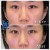 Middle Face Filler treatment 36 thumbnail