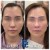 Middle Face Filler treatment 37 thumbnail
