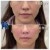 Middle Face Filler treatment 38 thumbnail