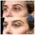 Middle Face Filler treatment 39 thumbnail