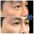 Middle Face Filler treatment 4 thumbnail