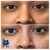 Middle Face Filler treatment 40 thumbnail