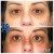 Middle Face Filler treatment 42 thumbnail