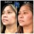 Middle Face Filler treatment 43 thumbnail