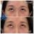 Middle Face Filler treatment 6 thumbnail