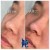 Middle Face Filler treatment 7 thumbnail