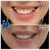 Lower Face/Neck Tox treatment 1 thumbnail