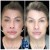 Lower Face/Neck Tox treatment 10 thumbnail