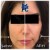 Lower Face/Neck Tox treatment 11 thumbnail