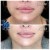 Lower Face/Neck Tox treatment 12 thumbnail