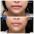 Lower Face/Neck Tox treatment 13 thumbnail