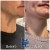 Lower Face/Neck Tox treatment 2 thumbnail