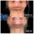 Lower Face/Neck Tox treatment 3 thumbnail