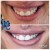 Lower Face/Neck Tox treatment 4 thumbnail