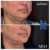 Lower Face/Neck Tox treatment 5 thumbnail