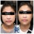 Lower Face/Neck Tox treatment 6 thumbnail
