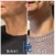 Lower Face/Neck Tox treatment 7 thumbnail