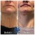 Lower Face/Neck Tox treatment 8 thumbnail