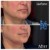 Lower Face/Neck Tox treatment 9 thumbnail