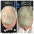 Needleless Hair treatment 3 thumbnail