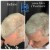 Needleless Hair treatment 5 thumbnail