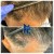 Needleless Hair treatment 6 thumbnail