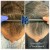 Needleless Hair treatment 7 thumbnail