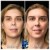 Pan Face Filler treatment 1 thumbnail