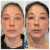 Pan Face Filler treatment 10 thumbnail