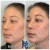 Pan Face Filler treatment 11 thumbnail