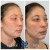 Pan Face Filler treatment 12 thumbnail