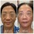 Pan Face Filler treatment 16 thumbnail