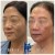 Pan Face Filler treatment 17 thumbnail