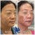 Pan Face Filler treatment 18 thumbnail