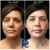 Pan Face Filler treatment 19 thumbnail