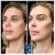 Pan Face Filler treatment 2 thumbnail